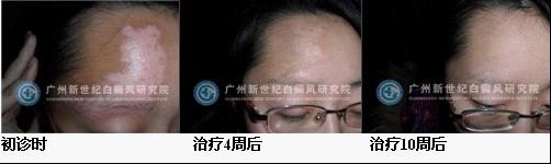 白颠风怎么治疗才好呢