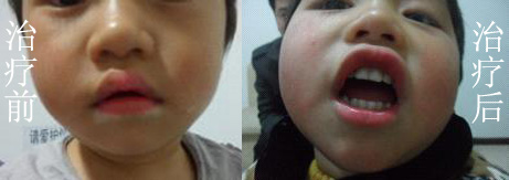 广东治疗白癜风的医院有哪些