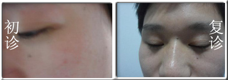 广州特发性点状白斑如何治疗