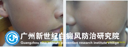 儿子的白癜风终于治好了
