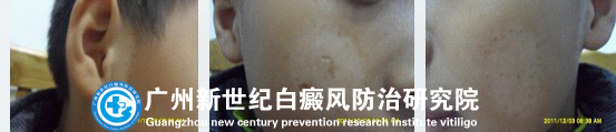 儿子的白癜风终于治好了